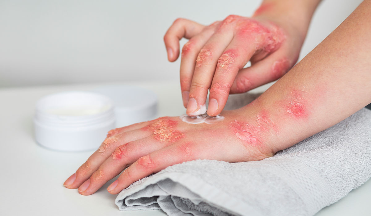 Understanding Eczema: Causes, Symptoms, and Treatment - Nigro ...